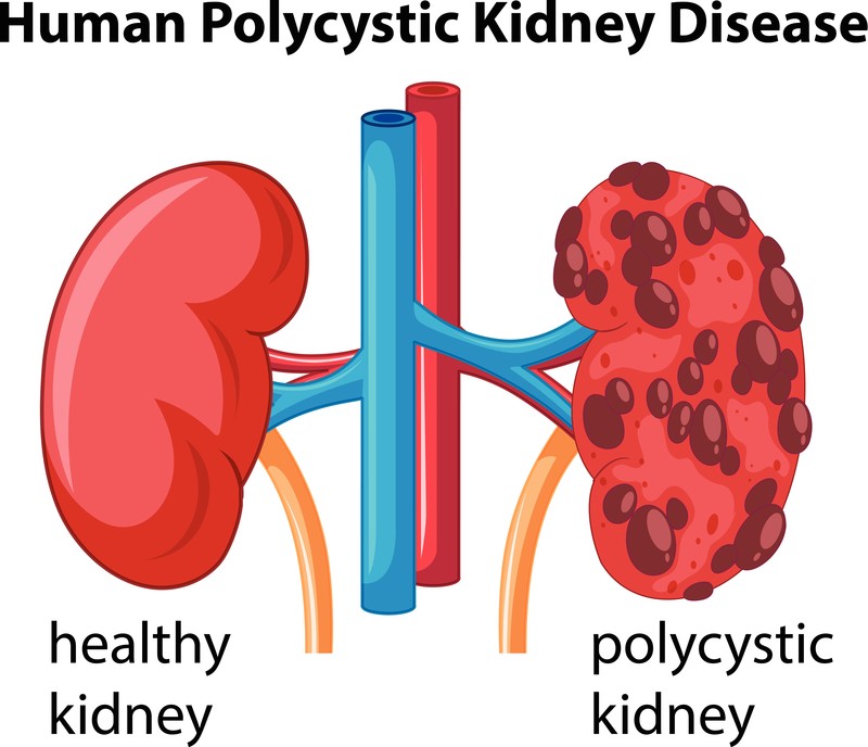 innovative-therapy-for-polycystic-kidney-disease-stem-cell-chicago