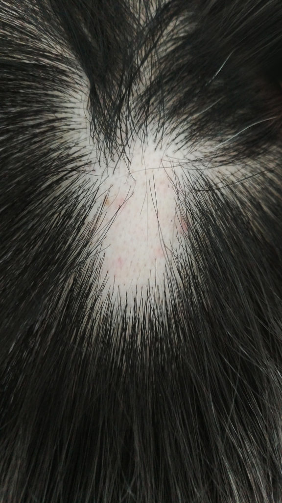 Understanding Alopecia Areata - Stem Cell Chicago